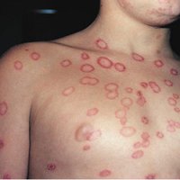 Ringworm lesions on chest