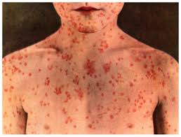 Measles rash on chest