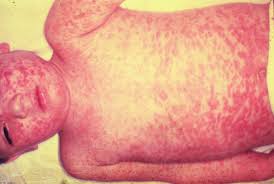 Measles rash on child