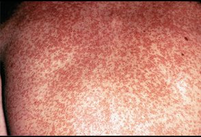 Rubella rash on child