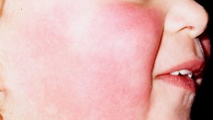 Slapped cheek appearance in fifth disease