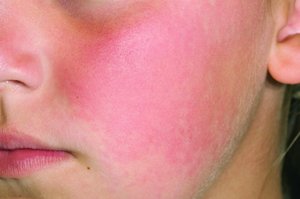 Fifth disease rash on face
