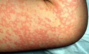 Fifth disease rash on body