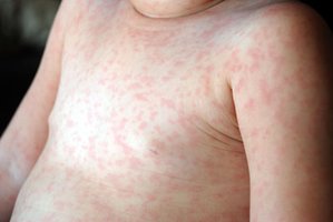 Roseola rash on trunk