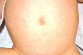 Roseola rash on child