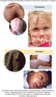 Chickenpox and smallpox comparison