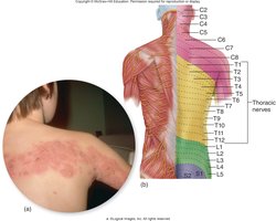 Shingles rash following a dermatome