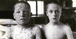 Smallpox lesions on children
