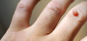 Common wart on finger