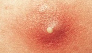 MRSA abscess on skin