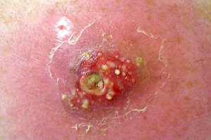 Carbuncle: deep, pus-filled abscess