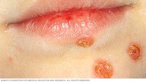 Impetigo lesions around the mouth