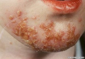 Impetigo lesions on the chin