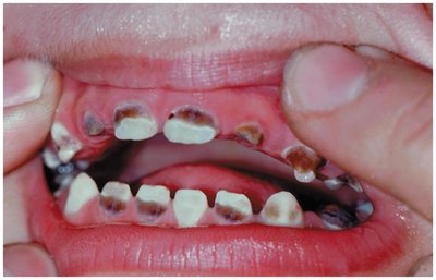 Dental plaque and tooth destruction