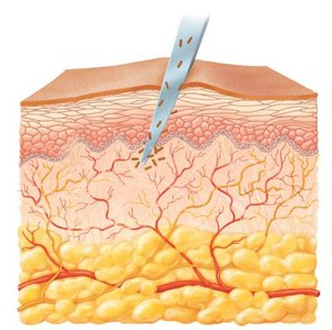 Tissue damage and inflammation
