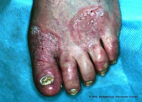 Tinea pedis (athlete's foot), a cutaneous mycosis