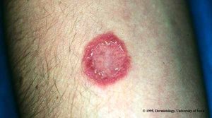 Tinea corporis (ringworm), a cutaneous mycosis