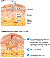 Stages of inflammation: tissue damage, vascular reactions, and phagocytosis