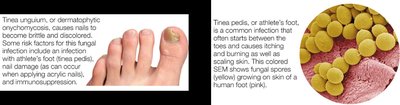 Dermatophyte infections (tinea)