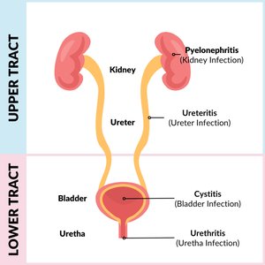 Diagram of upper and lower urinary tract infections