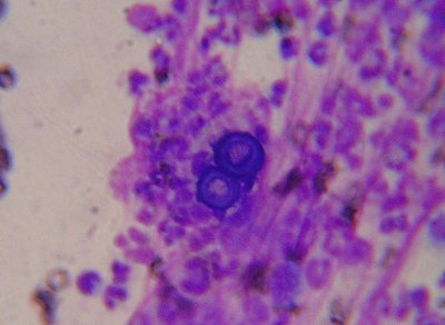 Blastomyces dermatidis yeast form and skin lesion