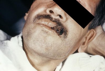 Histoplasma skin lesion