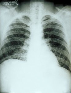 Diffuse lung infiltration on X-ray