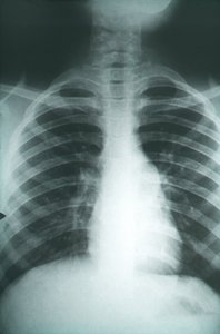 Coccidioidomycosis pneumonia X-ray