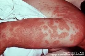 Coccidioidomycosis skin lesion