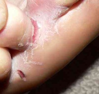 Ringworm on skin of arm