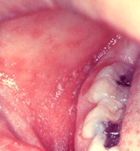 Measles rash
