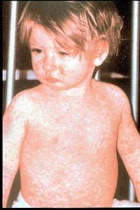 Measles rash on child