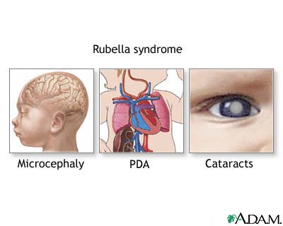 Rubella syndrome