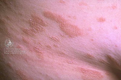 Roseola rash