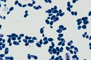 Candida albicans causing thrush