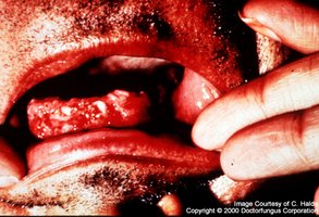 Oral lesions of histoplasmosis