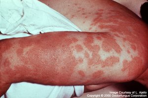 Rash due to systemic coccidiomycosis