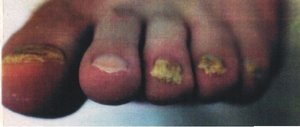 Toenail fungus (tinea unguium)