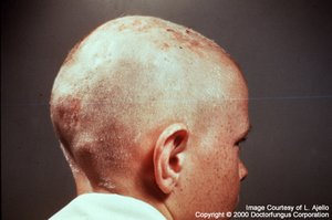 Ringworm of the scalp (tinea capitis)