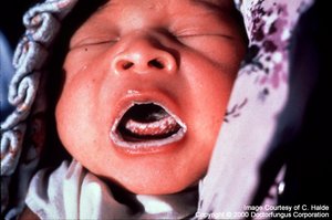 Thrush in an infant's mouth