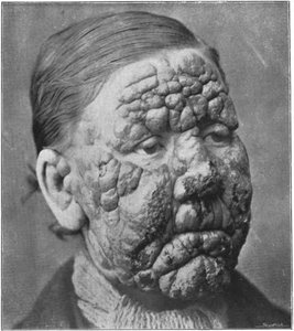 Leprosy facial disfigurement (historical)