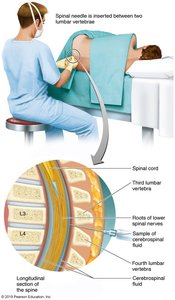 Lumbar puncture procedure for CSF collection