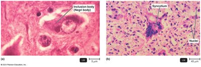 Cytopathic effects: inclusion bodies and syncytium