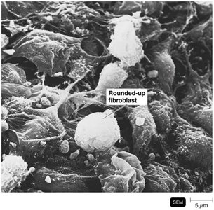 Human fibroblasts transformed by Rous Sarcoma Virus