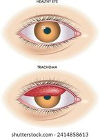 Healthy eye vs. trachoma