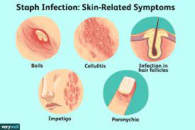 Staph infection skin symptoms