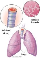 Diagram of pertussis bacteria and inflamed airway