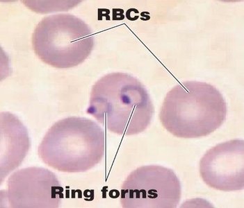 Ring forms of Plasmodium in red blood cells