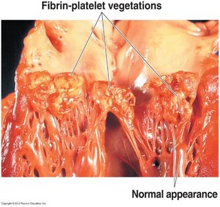 Fibrin-platelet vegetations on heart valves in endocarditis
