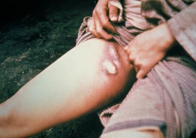 Buboes in the groin, characteristic of bubonic plague